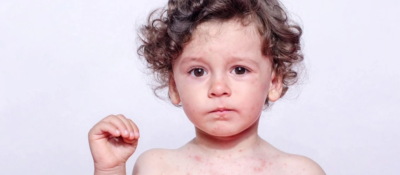 Η ιλαρά «σβήνει τη μνήμη» του ανοσοποιητικού μας συστήματος - Κίνδυνος για τα παιδιά